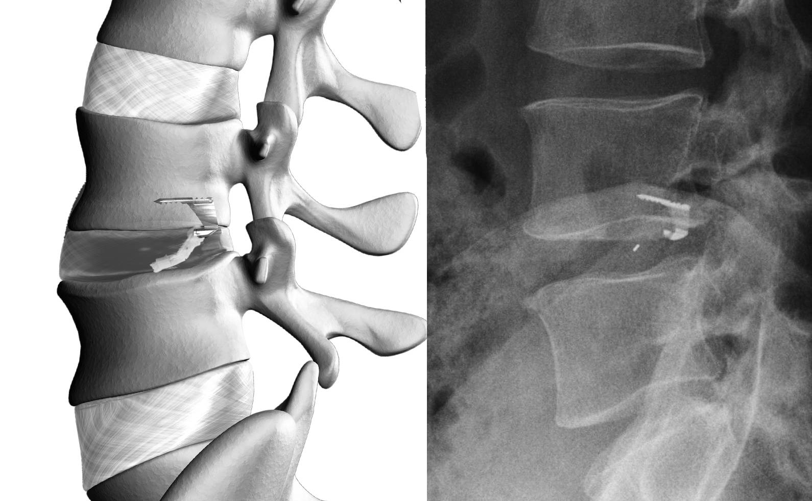 Barricaid surgery uoa university orthopaedic associates